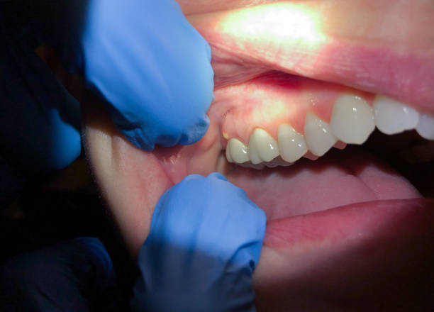 Best Emergency Dentist for Lost Fillings or Crowns in Moon Lake, FL
